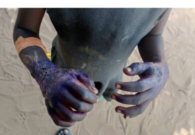 Tchad : une mère inflige de graves brûlures aux mains de sa fille de 6 ans après une accusation infondée de vol 