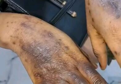Bénin : une dizaine de produits éclaircissants interdits pour risques sanitaires